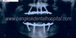 all-on-4 Zahnersatzt Implantate Vollständig Zahnloser Kiefer