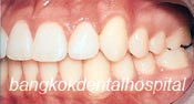Apr�s  Damon braces