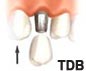 Dental-Implantat Zahnklinik bangkok thailand