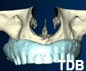 Teeth-in-an-hour Edentulous Kiefer bangkok thailand