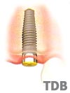 NobelDirect Implantat