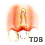 Implantatinsertion unmittelbar nach der Extraktion