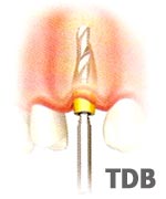Implantatinsertion unmittelbar nach der Extraktion