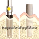 Immediate Funktion Zahn Implantat