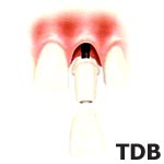 NobelSpeedy Groovy,Procera Abutment,Procera Crown