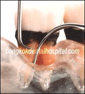 Parodontie clinique dentaire de Bangkok, parodontiste de thailand