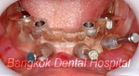 Implant teeth-in-an-hour